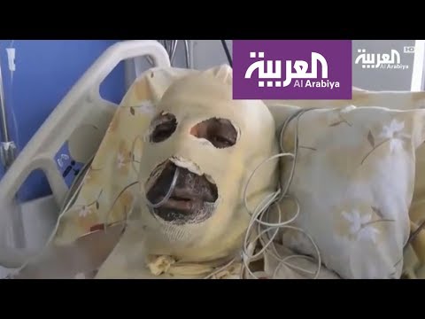 شاهد رياض خلف أب ولاجئ سوري أحرقه الفقر في لبنان