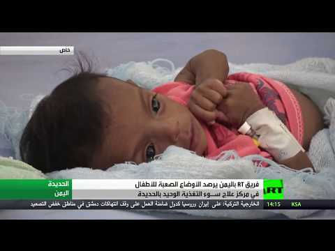 تفاقم مشكلة سوء التغذية في الحديدة