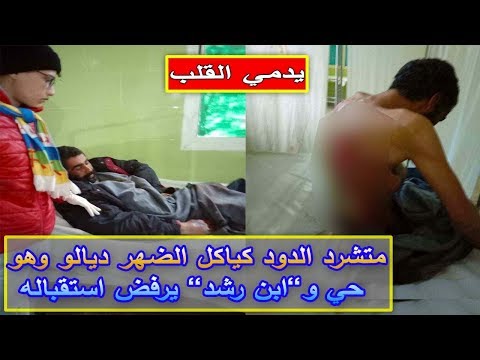 شاهد  الدود يأكل ضهر متشرّد ومستشفى ”ابن رشد” يرفض استقباله