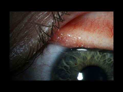 أول إنسان يصاب بديدان العيون ثيلازيا غولوسيا