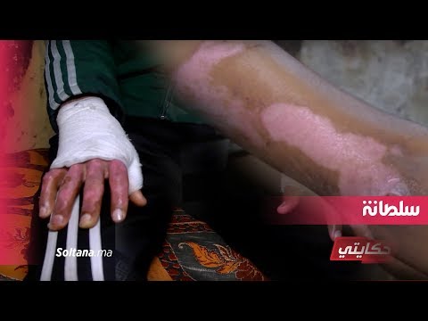 شاهد أب يعاني من اضطرابات أحرق منزله كاملا وأصاب أسرته بحروق بليغة