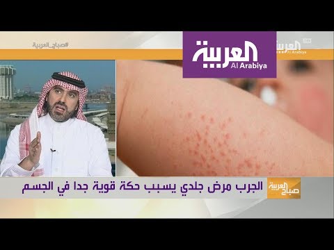 شاهد مرض الجرب ليس له علاقة بقلة النظافة