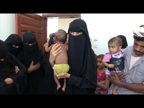 شاهد مرض سوء التغذية يفتك بأطفال اليمن