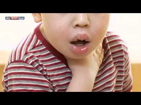 شاهد الحساسية مرض خطير يهدد صحة الأطفال