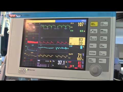 بالفيديو فصل توأمين سياميين في السعودية بنجاح