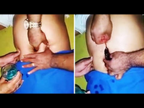 لحظة سحب فأر ميت من معدة رجل في البرازيل