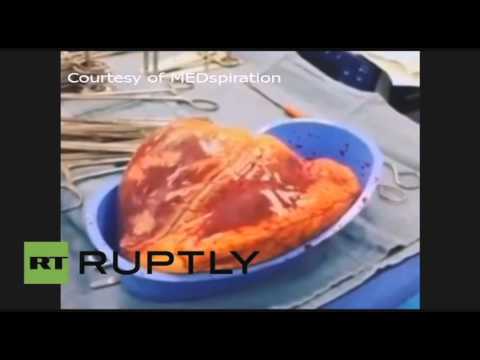 شاهد المخدرات تحافظ على نبض قلب مريض لمدة نصف ساعة