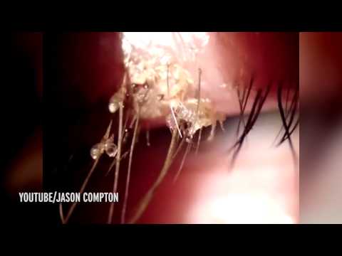 بالفيديو لقطات مروعة لـقمل ينمو على رموش العين