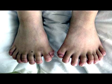 بالفيديو حالات مرضية غريبة ونادرة