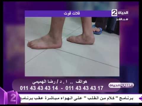 تعرف على أعراض فلات فوت وطريقة علاجه