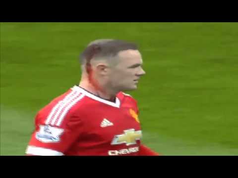 شاهد روني يستخدم التدبيس في علاج إصابته