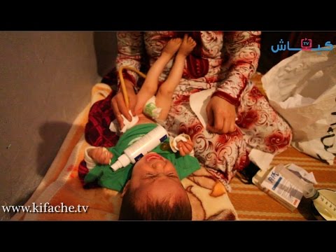 بالفيديو رضيع يحتاج لزراعة حنجرة