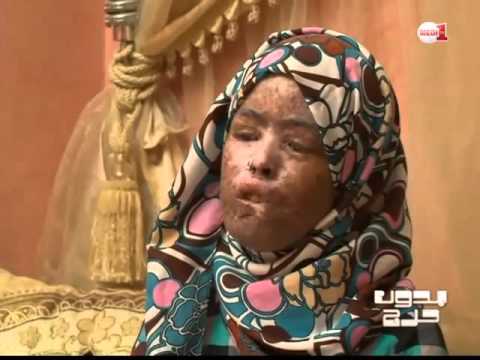 الشابة المغربية فاطمة الزهراء تتمرد بطموحها على مرضها