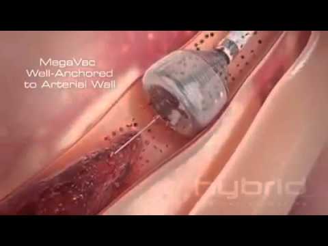 شاهد عملية فتح أوعية القلب