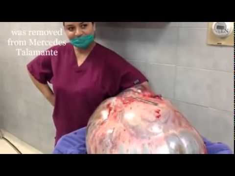 شاهد ماذا وجدوا في بطن امرأة تزن 275 كيلوغرامًا