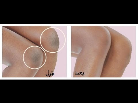 بالفيديو أسهل وأسرع طريقة لتفتيح البقع الداكنة