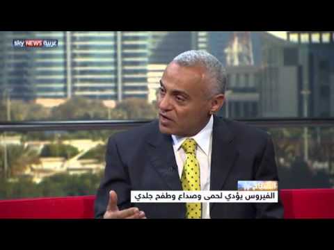 باحثون يؤكدون علاقة زيكا بصغر حجم الرأس