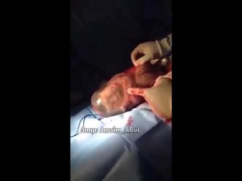 ولادة طفل بكيس الرحم