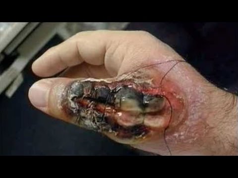 أخطر 10 حشرات فى العالم لسعتها قد تؤدّي إلى الموت