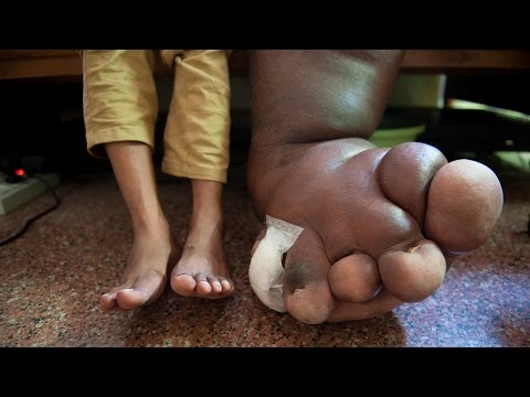 هندي مصاب بمرض نادر يجعل وزن ساقه 100 كيلو جرام