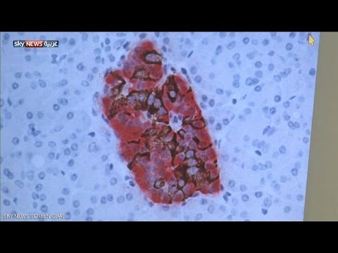 التشخيص الخاطئ للسكري يفاقم حالة المريض