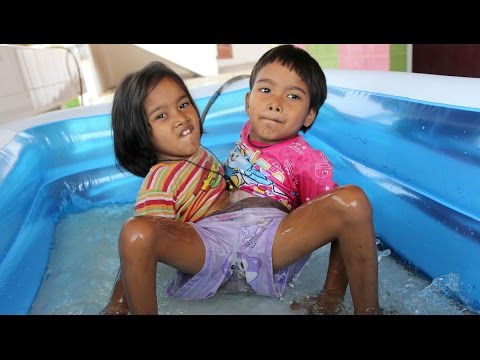 بالفيديو توأم تايلاندى ملتصق يرفض الانفصال عن بعضه